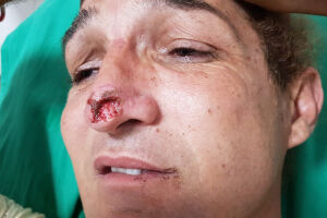Ex-namorado arranca pedaço de nariz e quebra dentes de ativista transexual