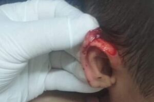 Criança de 3 anos tem orelha cortada com tesoura por coleguinha e mãe denuncia Ceinf