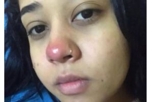 Jovem fica parapl&eacute;gica por causa de um piercing