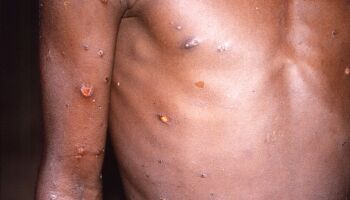 MS tem 22 casos suspeitos de varíola dos macacos; óbito pela doença foi descartado