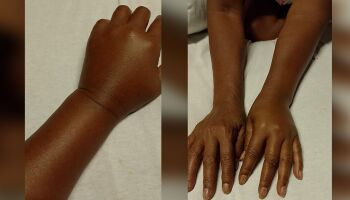 Aferição de pressão em braço com aneurisma deixa paciente com dor por 7 dias em Campo Grande