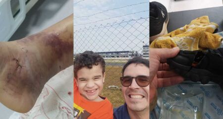 Marcas da cirurgia feita pelo Ricardo; pai e filho registraram momento antes do acidente; tênis rasgou após ser atingido pela peça
