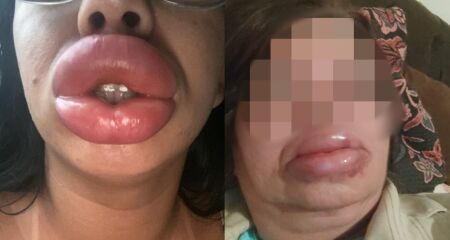 Até o momento, 3 mulheres procuraram a delegacia para denunciar estudante por erro em preenchimento labial em Campo Grande