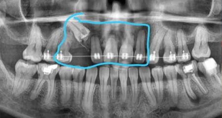 Cláudia Rafaela precisa de cirurgia urgente para retirar canino e 5 implantes