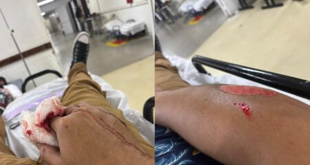 Motociclista teve fratura na mão e fez cirurgia de emergência após ser atingido por veículo na contramão no José Abrão