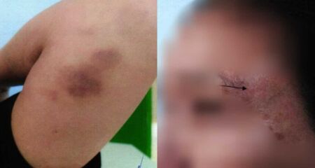 Vítima tinha marcas no rosto e nos braços de agressões cometidas pelo companheiro