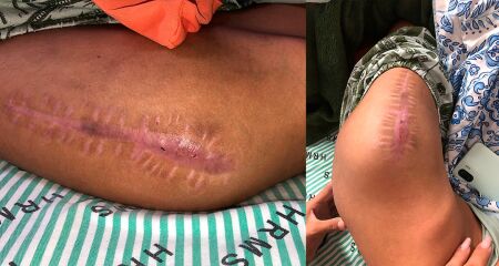 Perna do adolescente que aguarda atendimento ortopédico