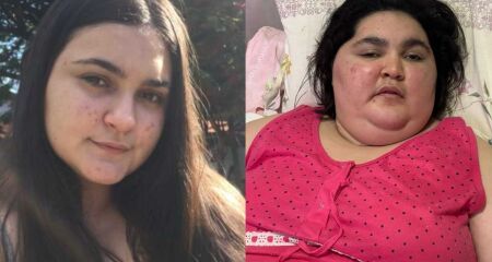 Jovem antes e depois das doenças