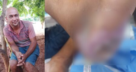Esposa fez vaquinha para custear despesas após marido ser internado com artrite séptica causada por bactéria no calcanhar