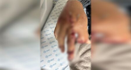O rapaz está internado na Santa Casa com ferimentos graves na mão