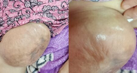 Joanilda dos Santos está há mais de 24 horas sem alimentação, à espera de cirurgia de urgência para tratar hérnia que compromete intestino