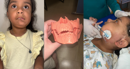 Hospital Universitário em Campo Grande é o primeiro de MS a usar tratamento de deformidades faciais severas em crianças