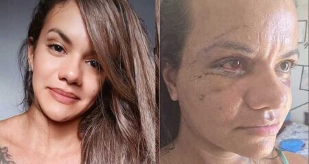 Juliana passou por uma cirurgia de reconstrução facial após sofrer múltiplas fraturas no rosto