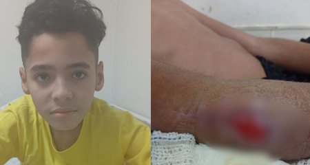 Com 65 dias de internação, adolescente deverá passar por cirurgia em outubro