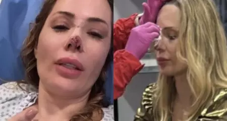 Brasileira Ju Isen foi mordida por um cachorro durante o Réveillon e vai passar pela terceira cirurgia de reconstrução facial