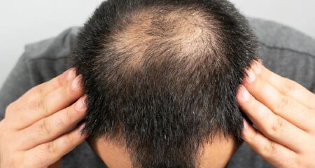 Estudo aponta que relação entre finasterida e transtornos mentais foi ignorada por 20 anos por autoridades de saúde