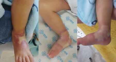 Família alega ter alertado, mais de uma vez, que o acesso estava com problemas; profissional teria dito que choro era provocado pela fome