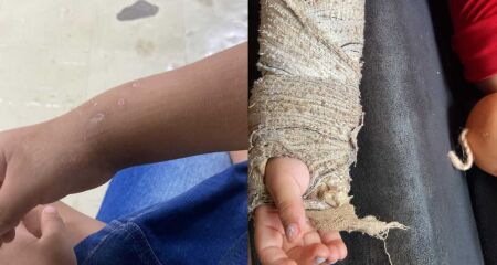 Criança segue com tala e pinos no braço após greve médica em Campo Grande