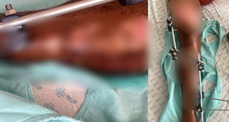 Morador de Anastácio sofreu acidente de moto e mesmo com fixador na perna denuncia "jogo de empurra" entre hospitais