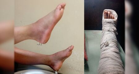 Dona de casa quebrou os dois pés em acidente doméstico