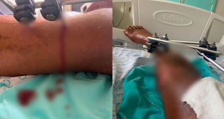 Homem ainda espera pela recuperação de sua perna