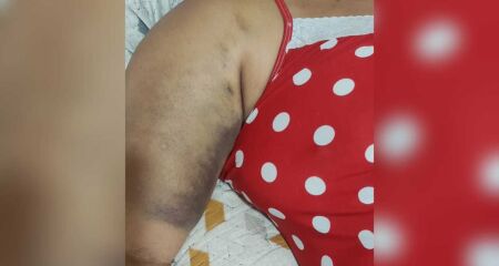 Com o braço quebrado há duas semanas, mulher saiu da Capital para se consultar no interior