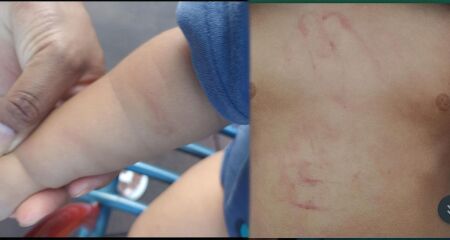 A crian&ccedil;a deu entrada em uma unidade de sa&uacute;de com hematomas em diferentes regi&otilde;es do corpo