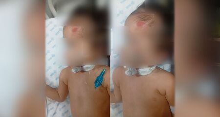 Menina passou recentemente por cirurgia para retirada de um tumor na Santa Casa e apresentou piora após novo procedimento