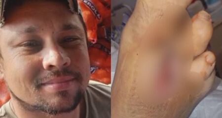 Fernando Maciel amputou est&aacute; h&aacute; dois meses sem renda por n&atilde;o poder trabalhar