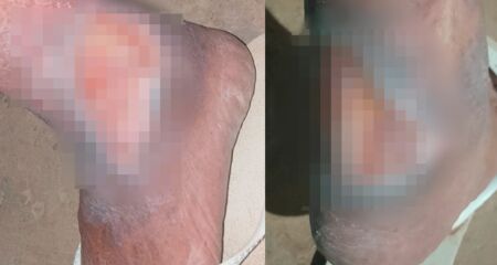 Aposentado gasta até R$ 600 por mês para cuidar de feridas que não cicatrizam