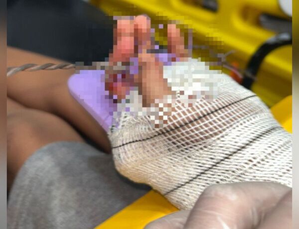 Menino tentou subir em muro durante esconde-esconde e precisou ser levado ao pronto-socorro