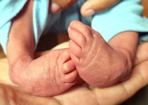 Casal precisa de ajuda para tratamento e cirurgia de bebê com pé congênito em Fátima do Sul