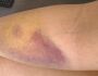 Enfermeiras são atacadas por paciente e denunciam descaso em Campo Grande
