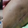 Um galão de água foi amarrado à perna da paciente, como um peso