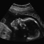 Segundo a Palícia Civil, o aborto e a morte do bebê chegaram a ser filmados pela adolescente