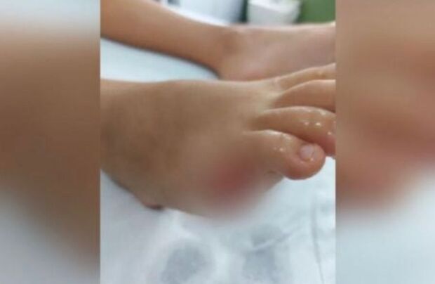 Criança perde dedo após ataque de piranha durante banho em lago