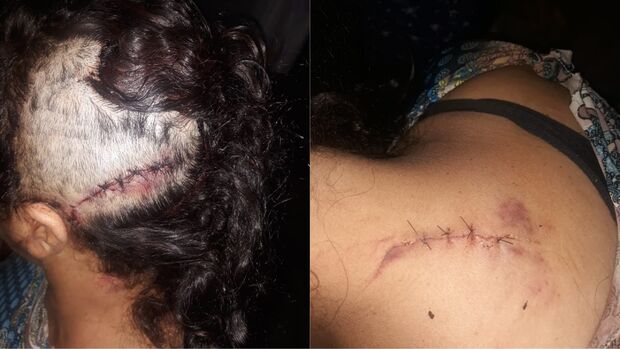 Sobrevivente: mulher atingida por foice precisa de ajuda em Campo Grande