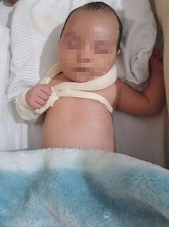Bebê tem clavícula quebrada, hospital esconde e mãe só fica sabendo um mês depois
