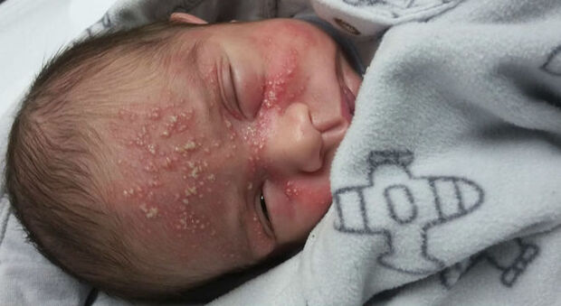 Bebê de 17 dias contrai herpes após beijo de visita e mãe alerta