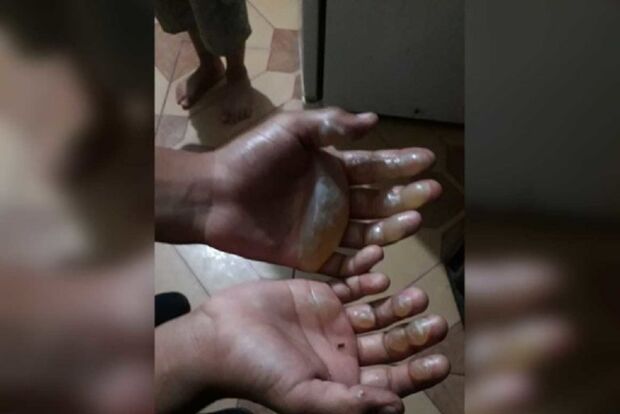 Mãe queima as mãos do filho por pegar moeda escondido
