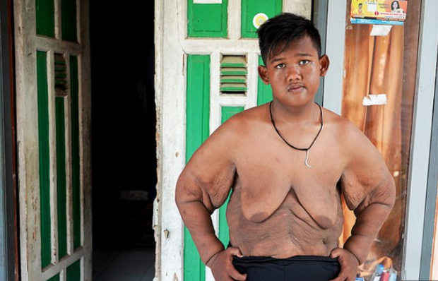 Menino que tinha quase 200 kg aos 10 anos perde mais da metade do peso