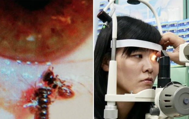 Médico retira quatro abelhas vivas dentro do olho de mulher