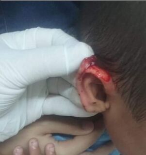 Criança de 3 anos tem orelha cortada com tesoura por coleguinha e mãe denuncia Ceinf
