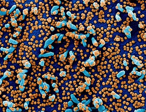 Imagens mostram ataque de Coronavírus a células humanas