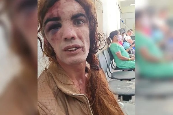 Transexual surda apanha e fica com rosto desfigurado no DF - Top Mídia News