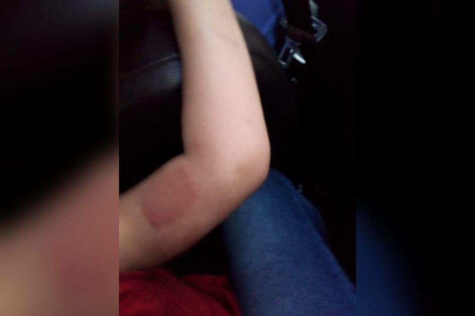 Criança sofre com alergias
