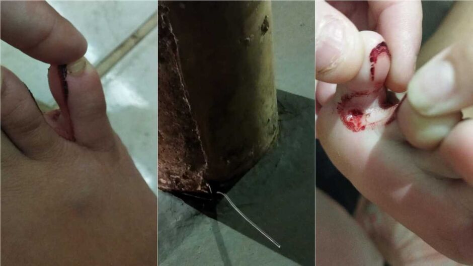 Mulher precisou tomar medicação por conta da perfuração