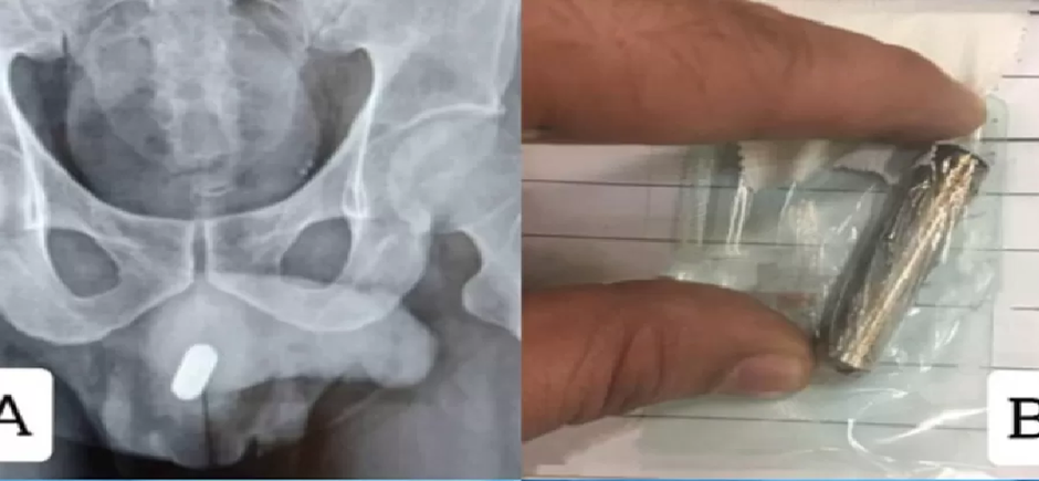 Ainda não se sabe como a pilha foi parar dentro do órgão genital do homem