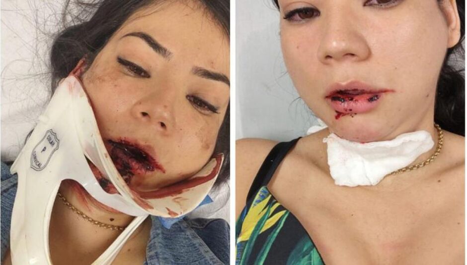 Jovem perdeu os dentes após se envolver em um acidente