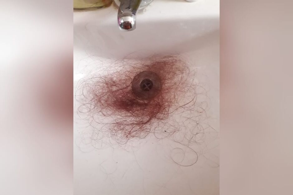 Cabelo da mulher passou a cair com mais frequência após a covid